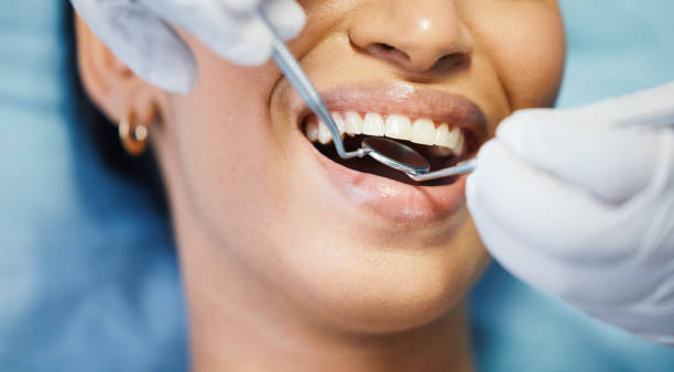 Best Emergency Dentist for Lost Fillings or Crowns in Panama City, FL
