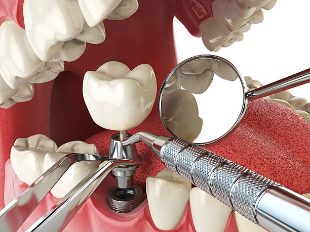 Best Emergency Root Canal Treatment in Panama City, FL